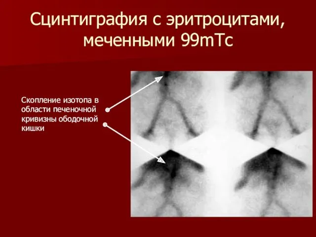 Сцинтиграфия с эритроцитами, меченными 99mТс Скопление изотопа в области печеночной кривизны ободочной кишки