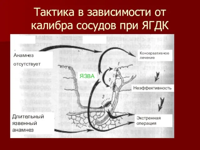 Тактика в зависимости от калибра сосудов при ЯГДК Анамнез отсутствует