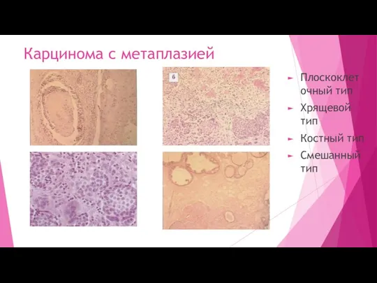 Карцинома с метаплазией Плоскоклеточный тип Хрящевой тип Костный тип Смешанный тип