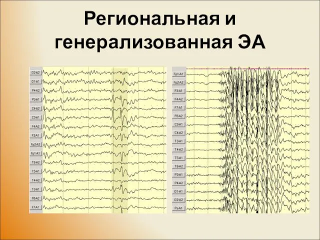 Региональная и генерализованная ЭА