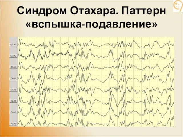 Синдром Отахара. Паттерн «вспышка-подавление»