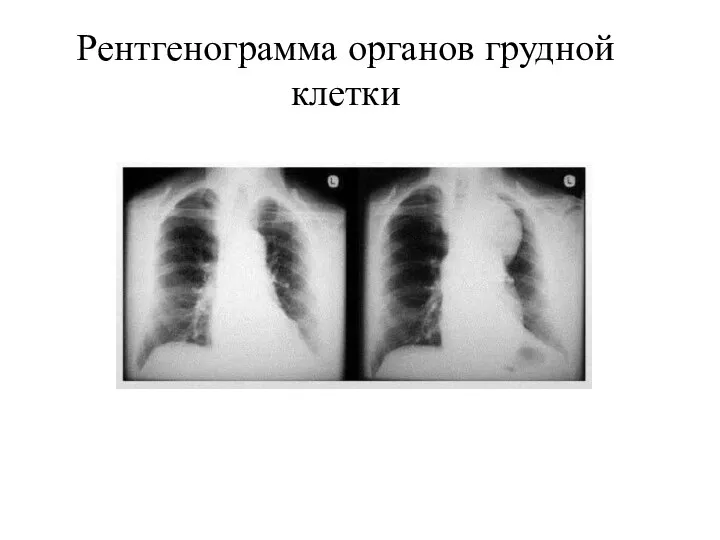 Рентгенограмма органов грудной клетки