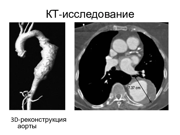 КТ-исследование 3D-реконструкция аорты