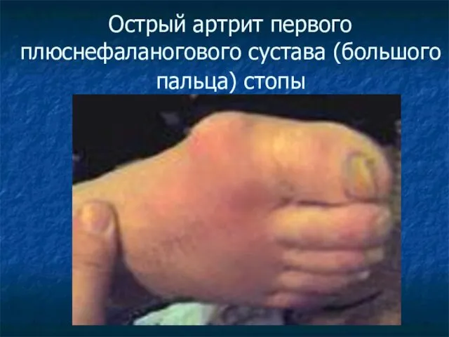 Острый артрит первого плюснефаланогового сустава (большого пальца) стопы