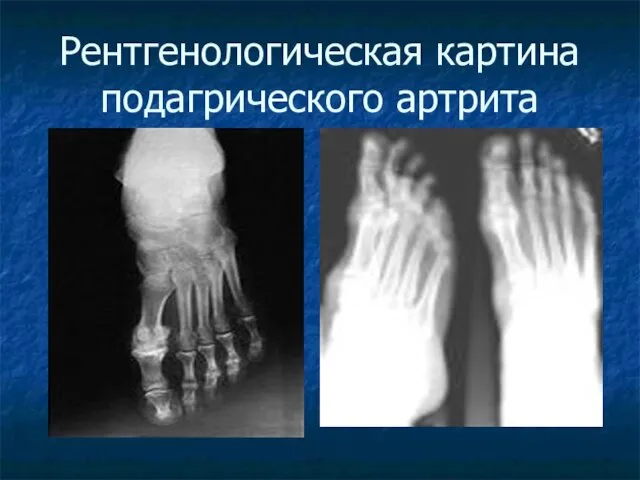 Рентгенологическая картина подагрического артрита