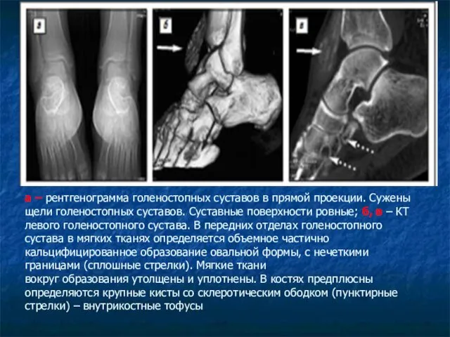 a – рентгенограмма голеностопных суставов в прямой проекции. Сужены щели