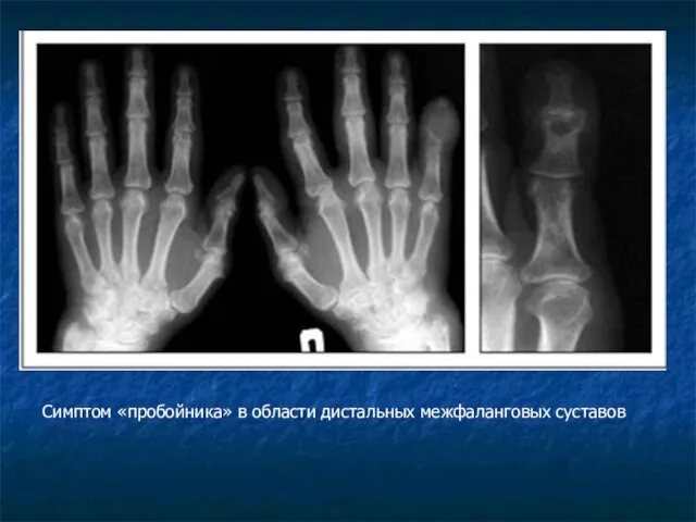 Симптом «пробойника» в области дистальных межфаланговых суставов