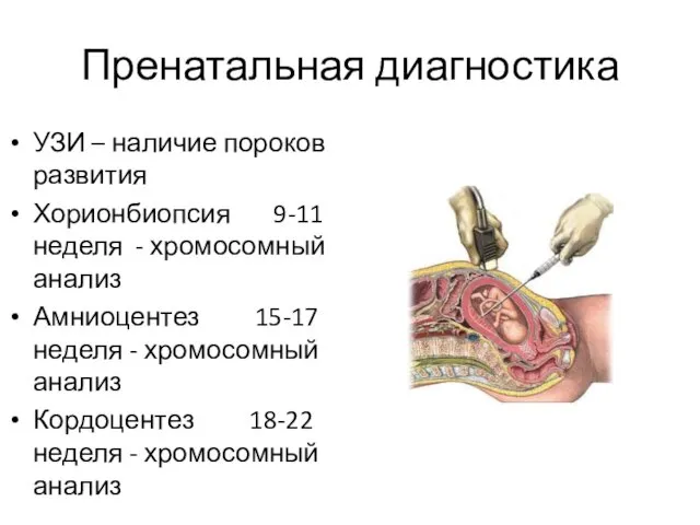 Пренатальная диагностика УЗИ – наличие пороков развития Хорионбиопсия 9-11 неделя