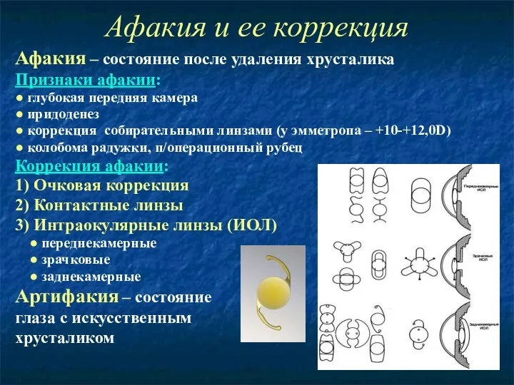 Афакия – состояние после удаления хрусталика Признаки афакии: ● глубокая