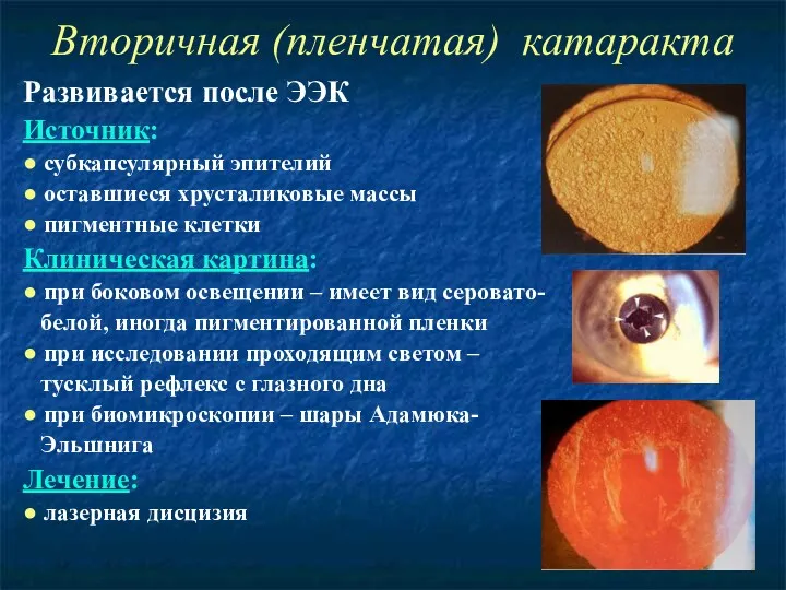 Развивается после ЭЭК Источник: ● субкапсулярный эпителий ● оставшиеся хрусталиковые