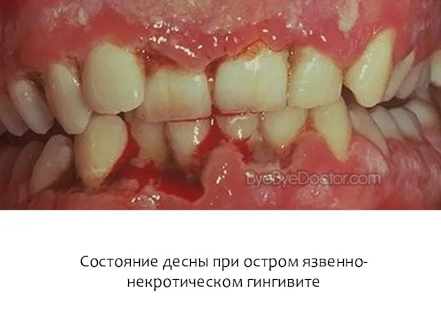 Состояние десны при остром язвенно-некротическом гингивите