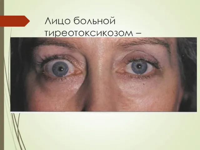 Лицо больной тиреотоксикозом – ассиметрия глаз