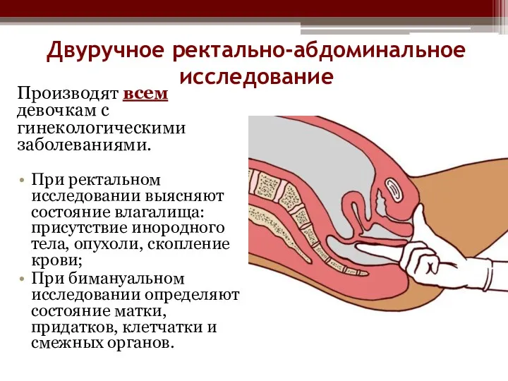 Двуручное ректально-абдоминальное исследование Производят всем девочкам с гинекологическими заболеваниями. При