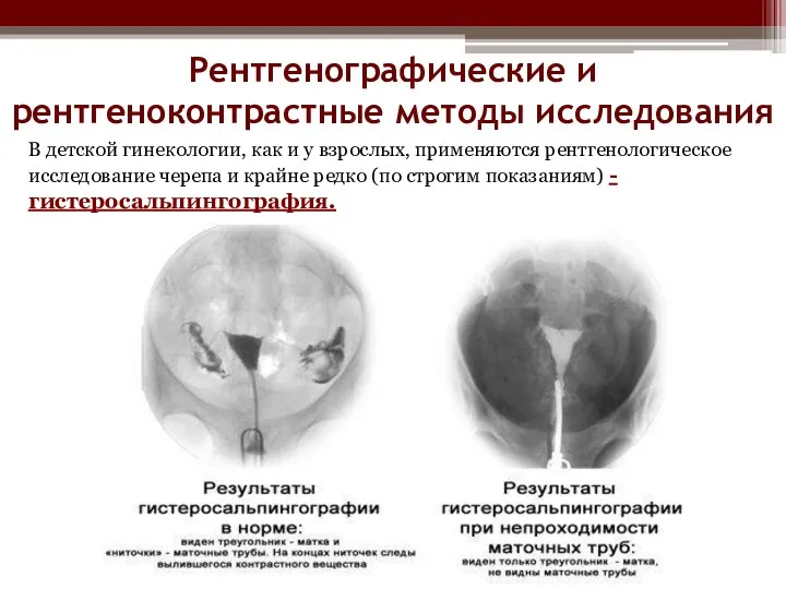 Рентгенографические и рентгеноконтрастные методы исследования В детской гинекологии, как и