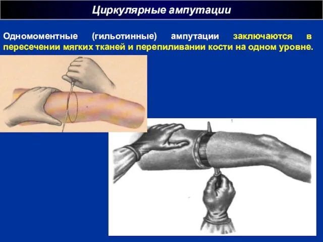 Циркулярные ампутации г Одномоментные (гильотинные) ампутации заключаются в пересечении мягких