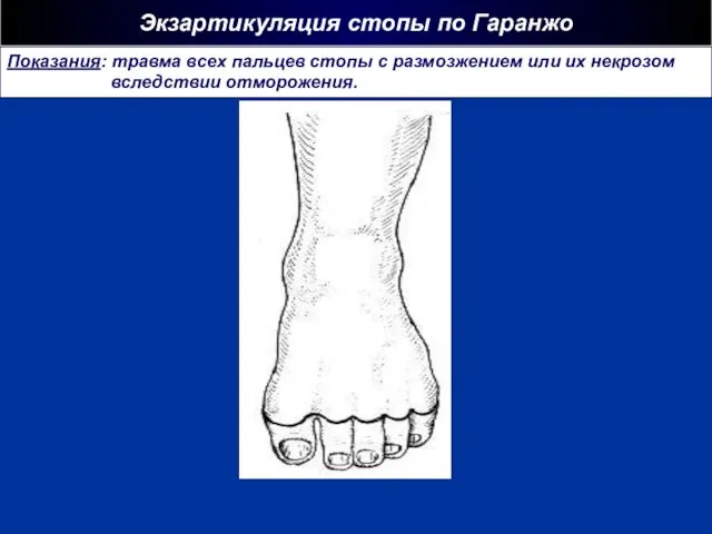 Экзартикуляция стопы по Гаранжо Показания: травма всех пальцев стопы с размозжением или их некрозом вследствии отморожения.