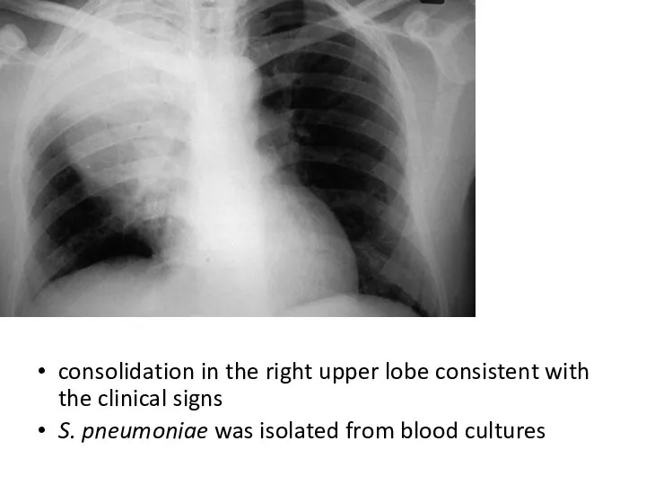 consolidation in the right upper lobe consistent with the clinical