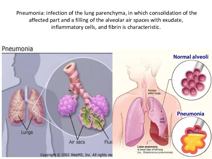 Pneumonia: infection of the lung parenchyma, in which consolidation of