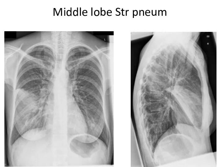 Middle lobe Str pneum