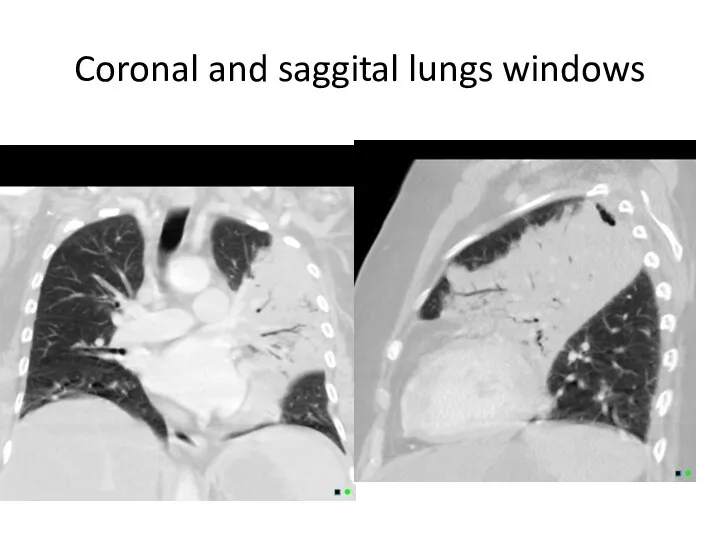 Coronal and saggital lungs windows