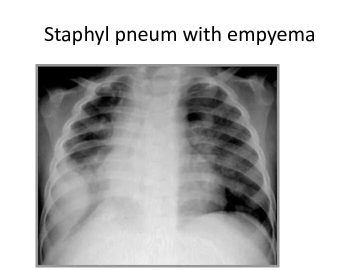 Staphyl pneum with empyema