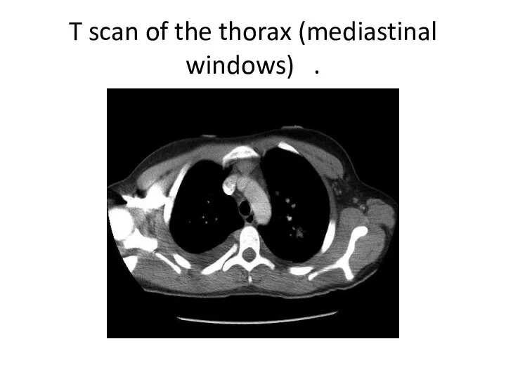 T scan of the thorax (mediastinal windows) .