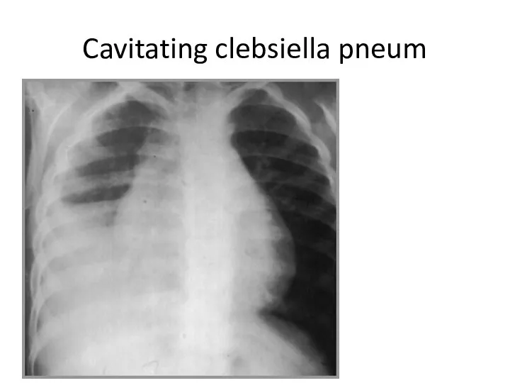Cavitating clebsiella pneum