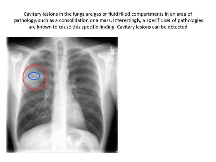 Cavitary lesions in the lungs are gas or fluid filled