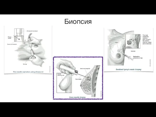 Биопсия