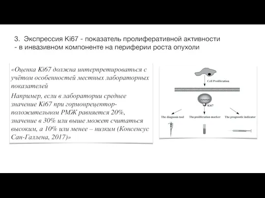 3. Экспрессия Ki67 - показатель пролиферативной активности - в инвазивном компоненте на периферии роста опухоли