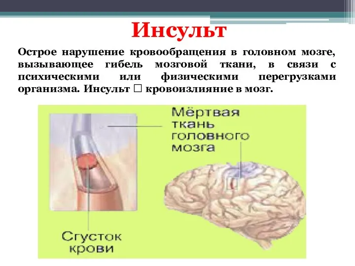 Инсульт Острое нарушение кровообращения в головном мозге, вызывающее гибель мозговой ткани, в связи
