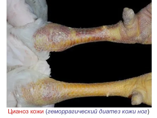 Цианоз кожи (геморрагический диатез кожи ног)
