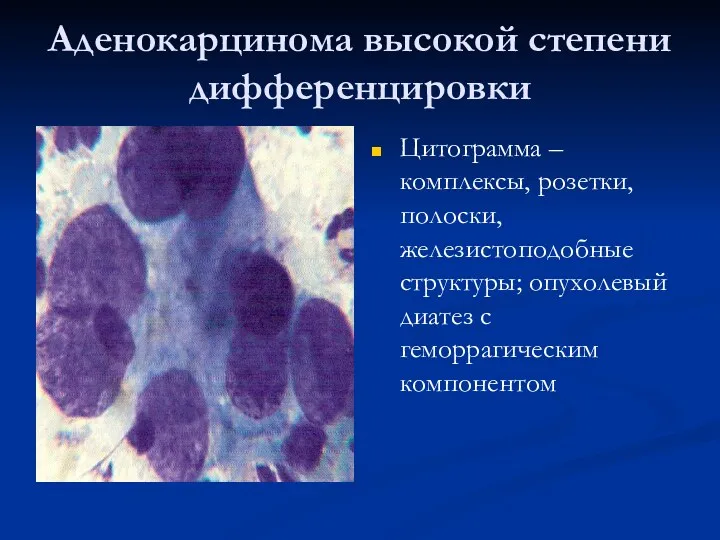 Аденокарцинома высокой степени дифференцировки Цитограмма – комплексы, розетки, полоски, железистоподобные структуры; опухолевый диатез с геморрагическим компонентом