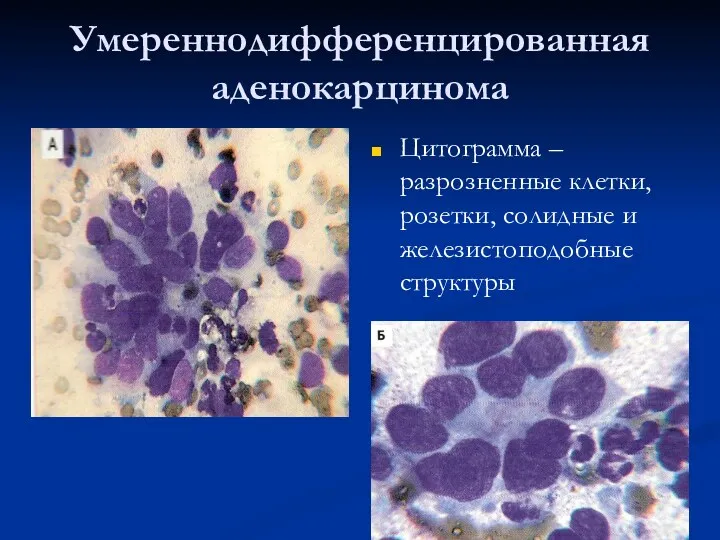 Умереннодифференцированная аденокарцинома Цитограмма – разрозненные клетки, розетки, солидные и железистоподобные структуры