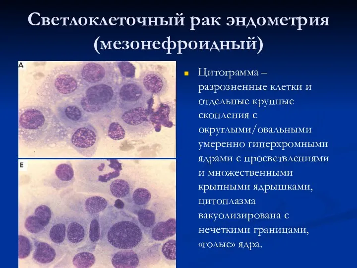 Светлоклеточный рак эндометрия (мезонефроидный) Цитограмма – разрозненные клетки и отдельные крупные скопления с