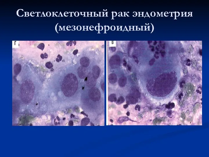 Светлоклеточный рак эндометрия (мезонефроидный)