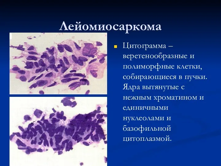 Лейомиосаркома Цитограмма – веретенообразные и полиморфные клетки, собирающиеся в пучки. Ядра вытянутые с