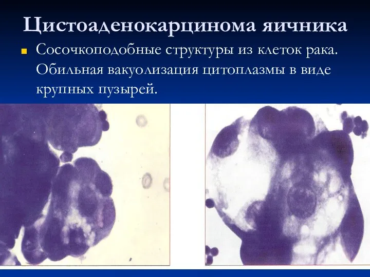 Цистоаденокарцинома яичника Сосочкоподобные структуры из клеток рака. Обильная вакуолизация цитоплазмы в виде крупных пузырей.