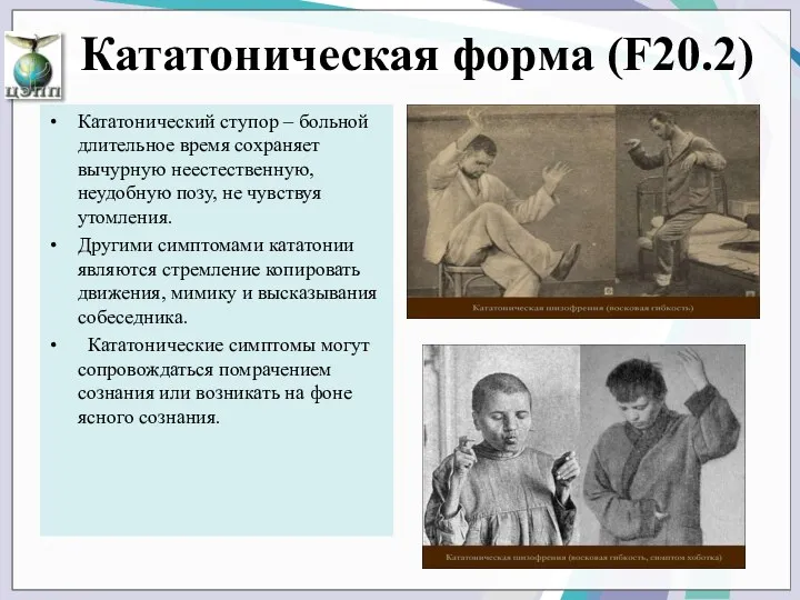 Кататоническая форма (F20.2) Кататонический ступор – больной длительное время сохраняет