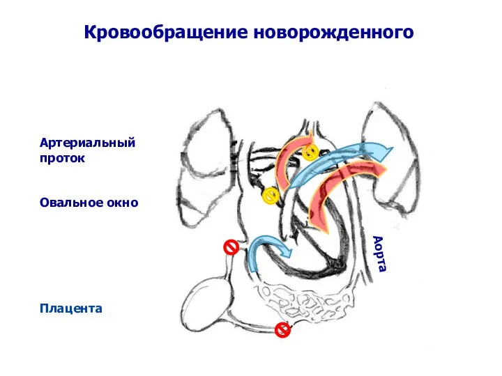 Кровообращение новорожденного Артериальный проток Овальное окно Плацента Аорта