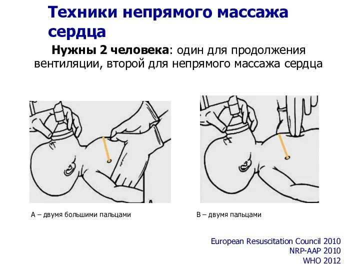 Техники непрямого массажа сердца A – двумя большими пальцами European