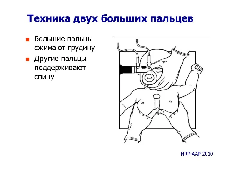 Техника двух больших пальцев Большие пальцы сжимают грудину Другие пальцы поддерживают спину NRP-AAP 2010