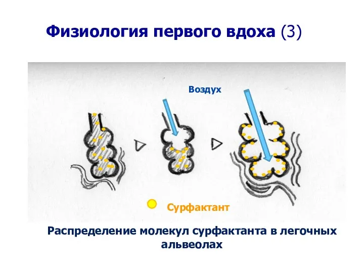 Физиология первого вдоха (3) Воздух Сурфактант Распределение молекул сурфактанта в легочных альвеолах