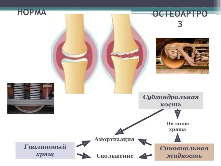 Амортизация Гиалиновый хрящ Синовиальная жидкость Скольжение Питание хряща Субхондральная кость НОРМА ОСТЕОАРТРОЗ