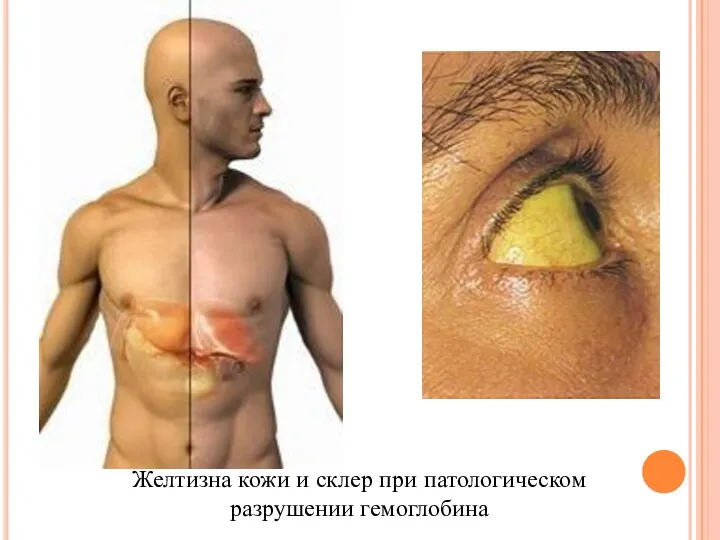 Желтизна кожи и склер при патологическом разрушении гемоглобина