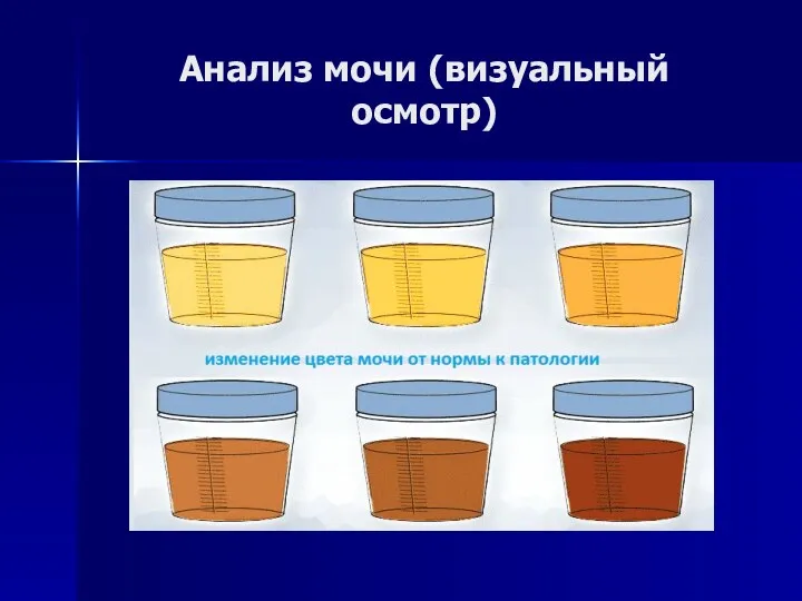 Анализ мочи (визуальный осмотр)