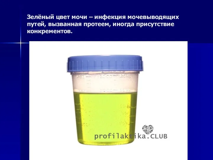 Зелёный цвет мочи – инфекция мочевыводящих путей, вызванная протеем, иногда присутствие конкрементов.