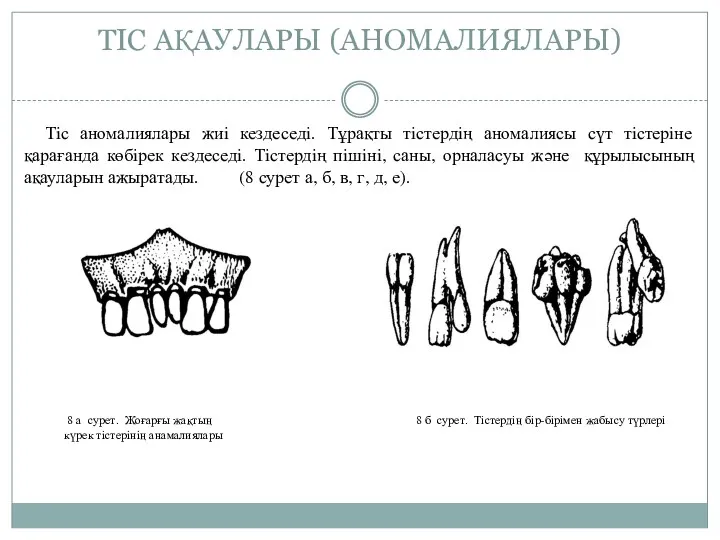 ТIС АҚАУЛАРЫ (АНОМАЛИЯЛАРЫ) Тiс аномалиялары жиi кездеседi. Тұрақты тiстердiң аномалиясы