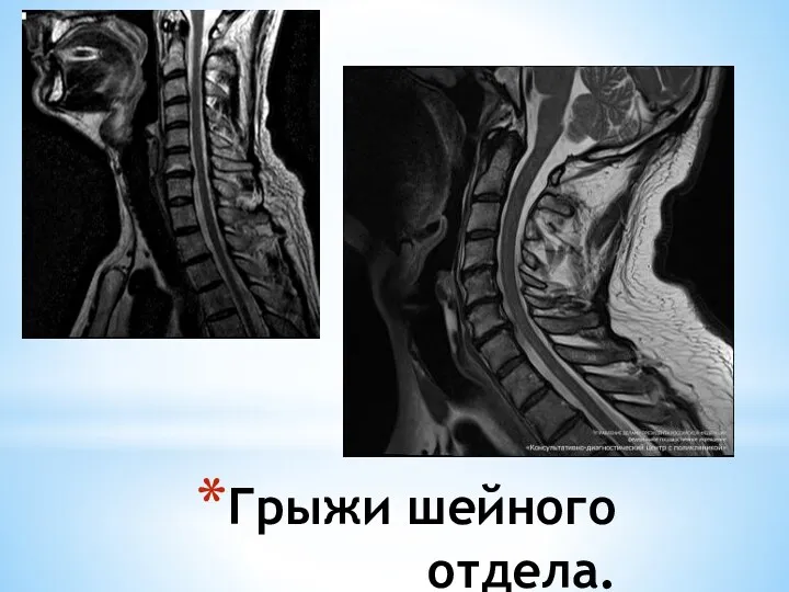 Грыжи шейного отдела.