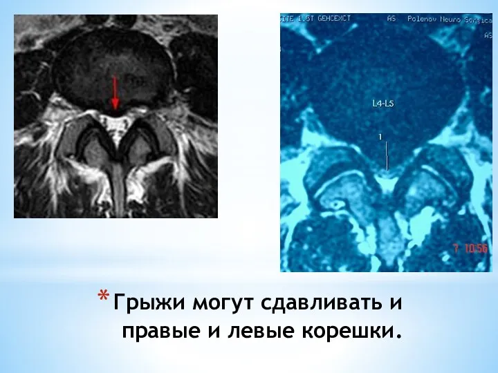 Грыжи могут сдавливать и правые и левые корешки.